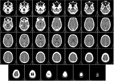 Computed tomography of human brain - large