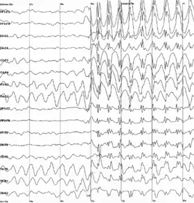 The electroencephalogram recording of a person with childhood absence epilepsy showing a seizure. The waves are black on a white background.